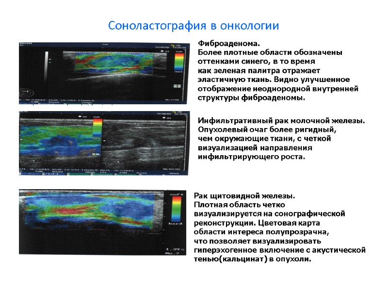 Соноластография в онкологии Инфильтративный рак молочной железы. Опухолевый очаг более ригидный,  чем окружающие